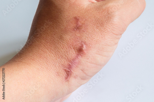 The scar on his arm near the wrist on a white background. Two scars next to each other on the arm  close-up. Not isolated.