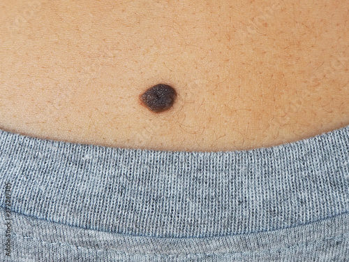 Closeup mole of skin lesion cause of proliferation of pigment derma cells and melanocytic pigmented naevus on the photo
