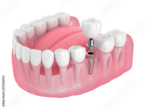 3d render of jaw with dental implant photo