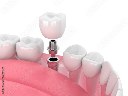 Принти на полотні 3d render of jaw with dental implant