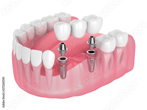 3d render of jaw with implants supported dental bridge