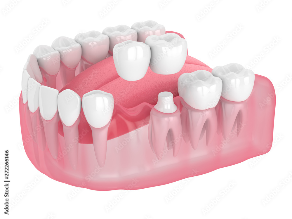3d render of jaw with cantilever bridge 3d render of jaw with cantilever bridge