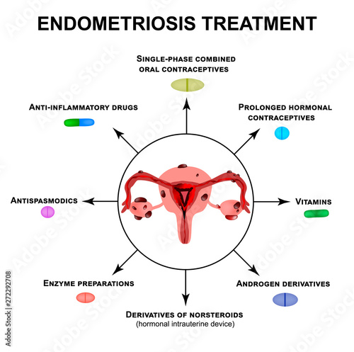 Treatment of endometriosis. Adenomyosis. The structure of the pelvic organs with endometriosis. Infographics. Vector illustration on isolated background.