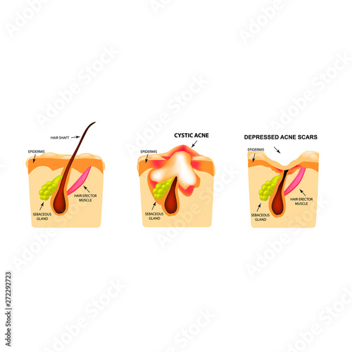 comedones, inflamed acne, cysts. Inflamed pimples. The structure of the skin. Scar acne and pimples. Infographics. Vector illustration on isolated background.