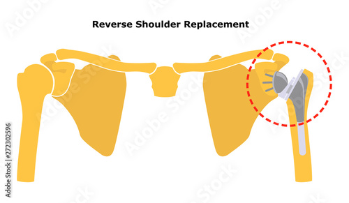 Reversible Shoulder Replacement. Shoulder joint replacement, endoprosthetics. Osteoarthrosis of the shoulder joint. Vector illustration. Flat design.