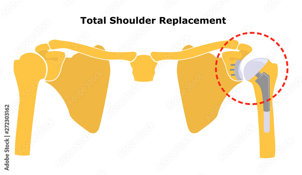 Total Shoulder Replacement. Shoulder joint replacement, endoprosthetics