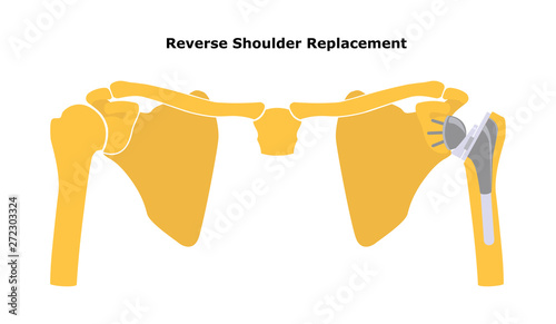 Reversible Shoulder Replacement. Shoulder joint replacement, endoprosthetics. Osteoarthrosis of the shoulder joint. Vector illustration. Flat design.