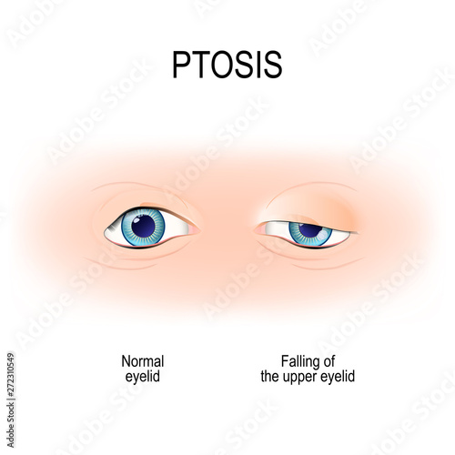 Ptosis is a drooping of the upper eyelid. lazy eye