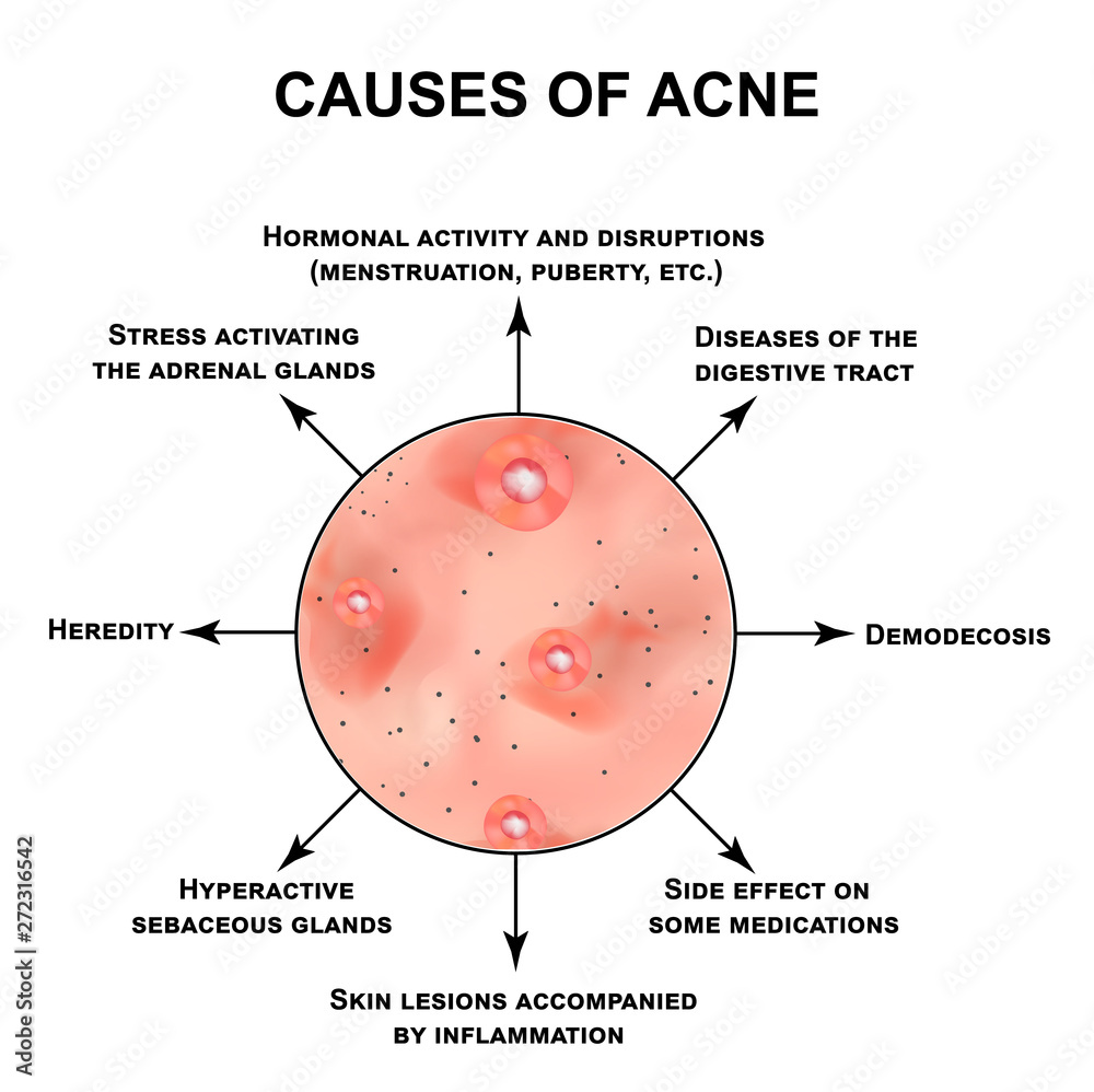 Vecteur Stock Causes Of Acne Pustules Papules Comedones Blackheads vecteur-stock-causes-of-acne-pustules-papules-comedones-blackheads