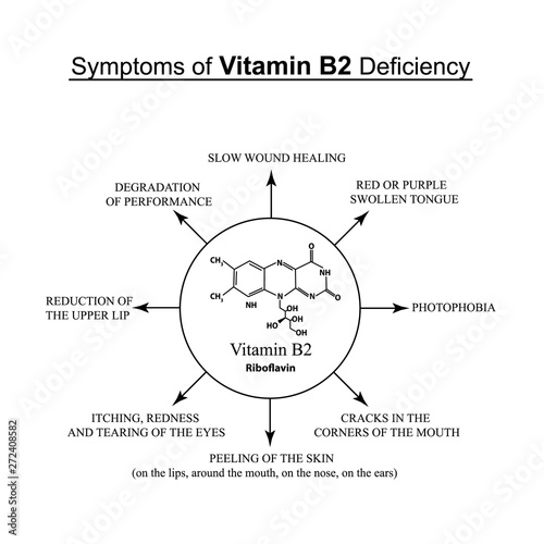 Symptoms of vitamin B2 deficiency. Infographics. Vector illustration on an isolated background.