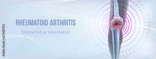 Vertical light rheumatoid arthritis Bones the of knee