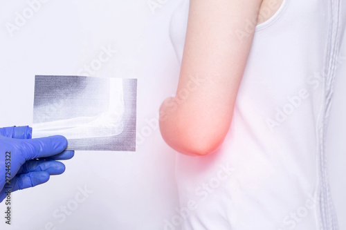 A patient girl who has an elbow ache at a doctor s appointment with a medical bursitis examination of the elbow, close-up photo