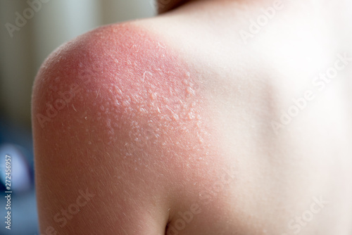 Skin care concept. Handsome guy got sunburn and got tan lines on his shoulder. The skin sloughs off its his burn skin. It is the cause of melanoma. He has a burning pain on his shoulder. He get suffer