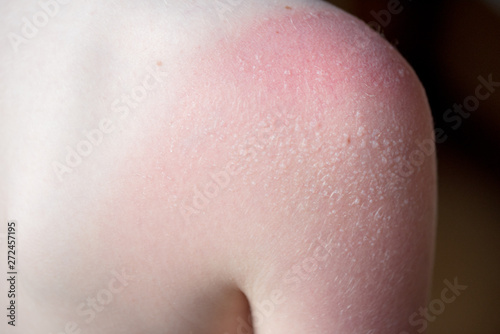 Skin care concept. Handsome guy got sunburn and got tan lines on his shoulder. The skin sloughs off its his burn skin. It is the cause of melanoma. He has a burning pain on his shoulder. He get suffer