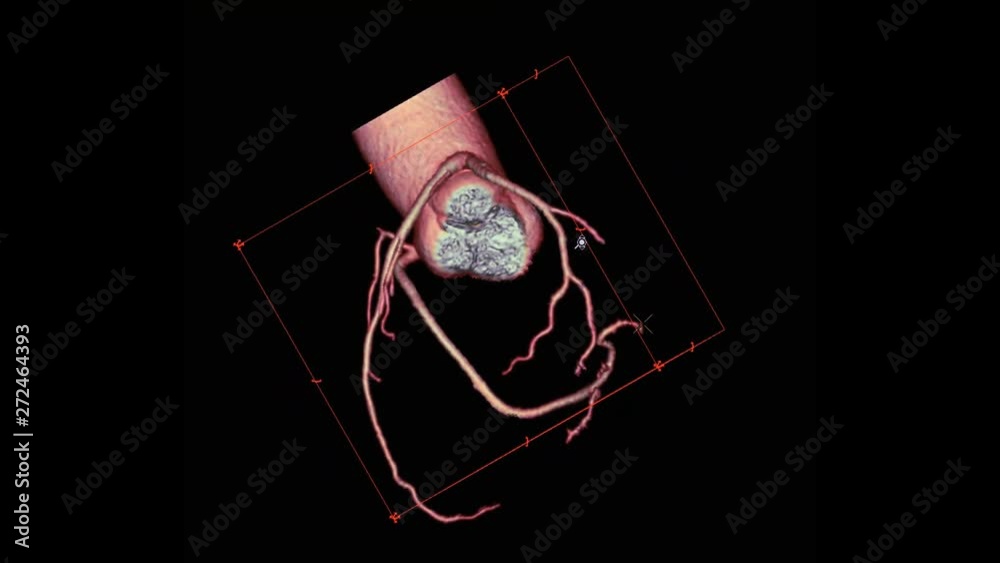 CTA Coronary artery 3D rendering image turn around on the screen for ...