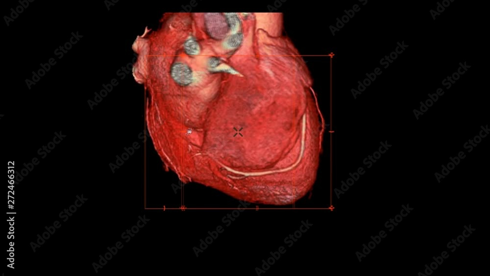 Vidéo Stock CTA Coronary artery 3D rendering image turn around on the ...