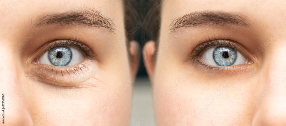 A closeup view on the blue eyes of a young pretty lady, split screen is used