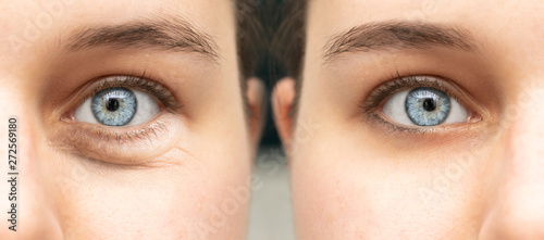 A closeup view on the blue eyes of a young pretty lady, split screen is used to show the results of oculoplastic surgery, a procedure to remove swollen and puffy eye bags.