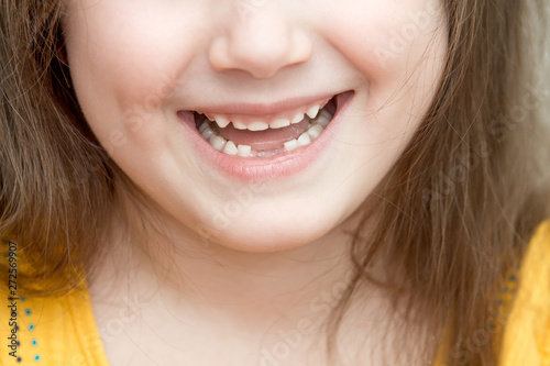 Childish face lower part with missing front lower milk teeth in a smiling mouth