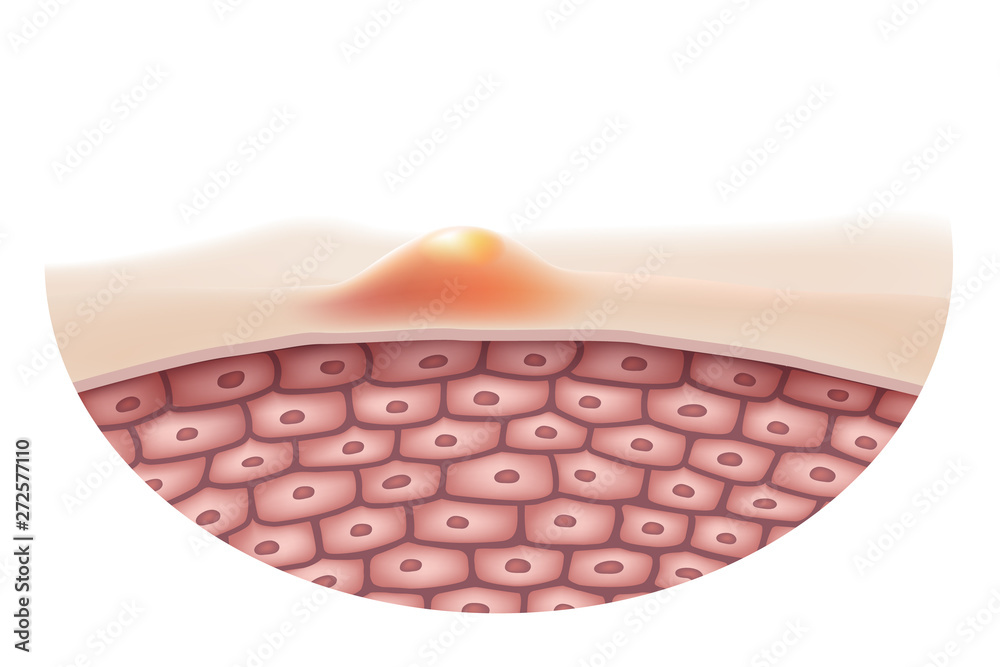 The concept of skin that is acne or inflammation on human skin Is a medical symbol for the treatment of skin diseases By using drugs or lasers to treat. Vector Realistic file. The concept of skin that is acne or inflammation on human skin Is a medical symbol for the treatment of skin diseases By using drugs or lasers to treat. Vector Realistic file.