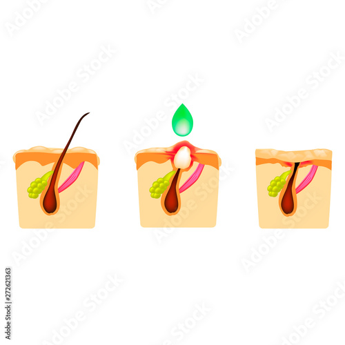 Treatment of open comedones, inflamed acne, acne cysts. Sore acne. The structure of the skin. Treatment of scars of acne and pimples. Peeling. Infographics. Vector illustration on isolated background.