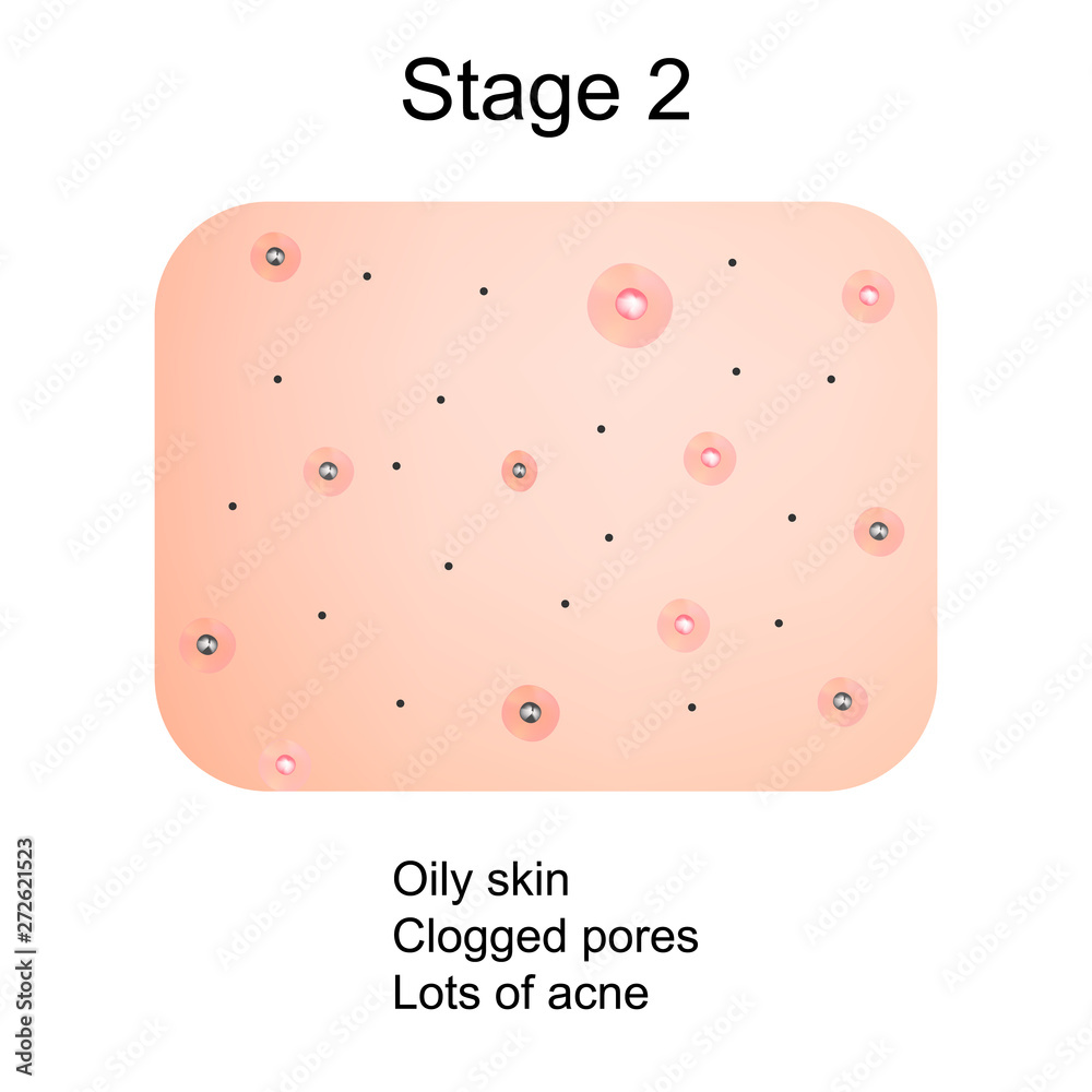 Stage 2 of development of acne. Inflamed skin with scars, acne and ...