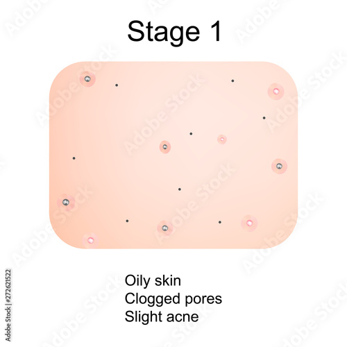Stage 1 of development of acne. Inflamed skin with scars, acne and pimples. The texture of inflamed skin, and acne and pimples. Infographics. Vector illustration.