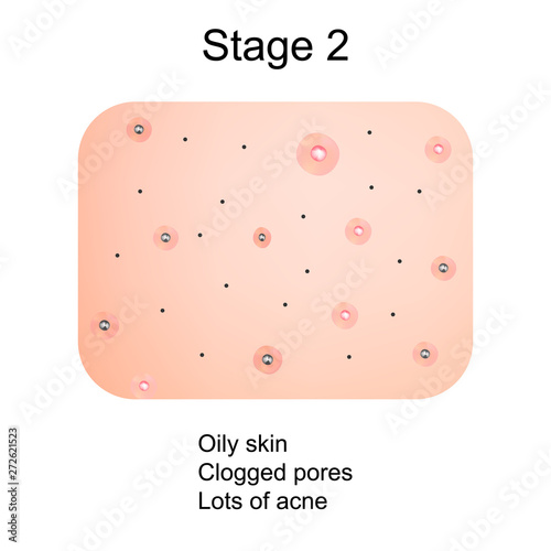 Stage 2 of development of acne. Inflamed skin with scars, acne and pimples. The texture of inflamed skin, and acne and pimples. Infographics. Vector illustration.