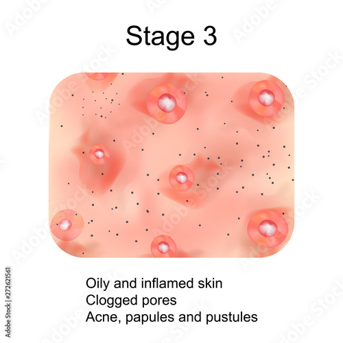 Stage 3 of development of acne. Inflamed skin with scars, acne and pimples. The texture of inflamed skin, and acne and pimples. Infographics. Vector illustration.