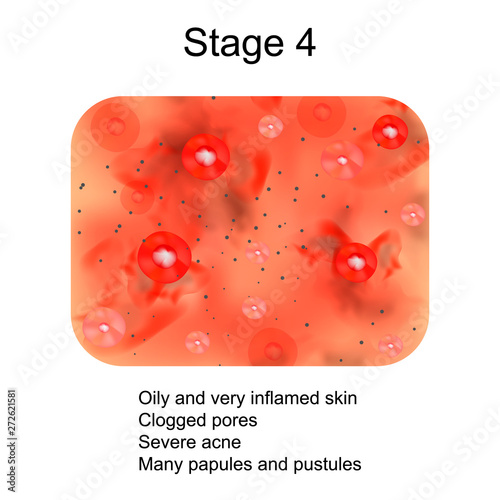 Stage 4 of development of acne. Inflamed skin with scars, acne and pimples. The texture of inflamed skin, and acne and pimples. Infographics. Vector illustration.