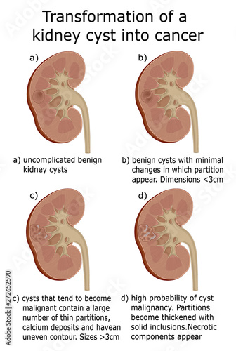 Illustration of transformation of a kidney cyst into cancer