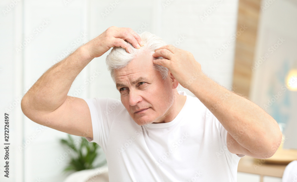 Senior man with hair loss problem indoors Senior man with hair loss problem indoors