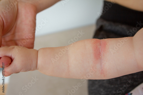 Prickly heat. Close-up of the folds of the hand of a newborn baby with red skin. 