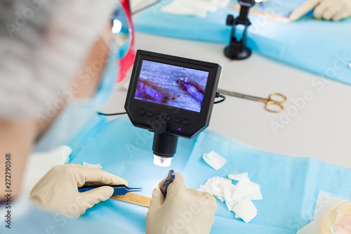 The doctor under the microscope recalculates the hair follicles. Baldness treatment. Hair transplant. Surgical technique that moves hair follicles from a part of the head. photo