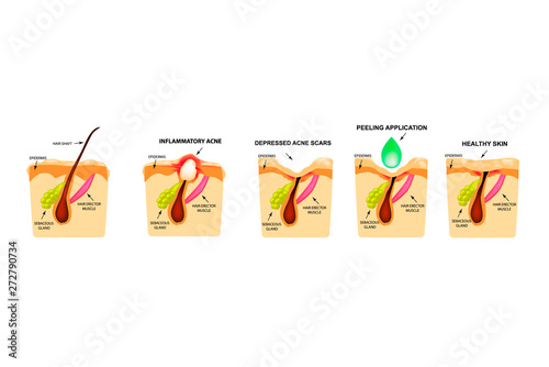 Treatment of open comedones, inflamed acne, acne cysts. Sore acne. The structure of the skin. Treatment of scars of acne and pimples. Peeling. Infographics. Vector illustration on isolated background.