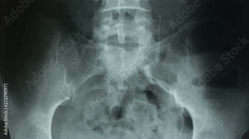 Vertical tracking, of a urography with a contrast method of the kidneys and the human bladder. photo