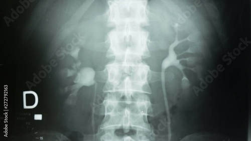 Vertical tracking, of a urography with a contrast method of the kidneys and the human bladder. photo