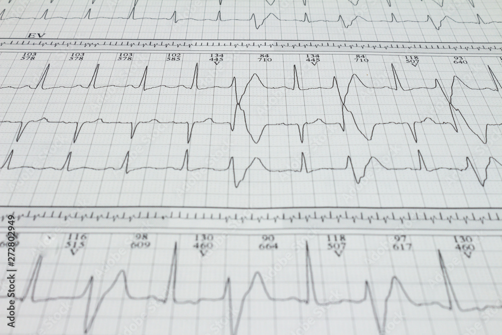 Ventricular extrasystole Bigeminism Cardiac arrhythmia recorded on an