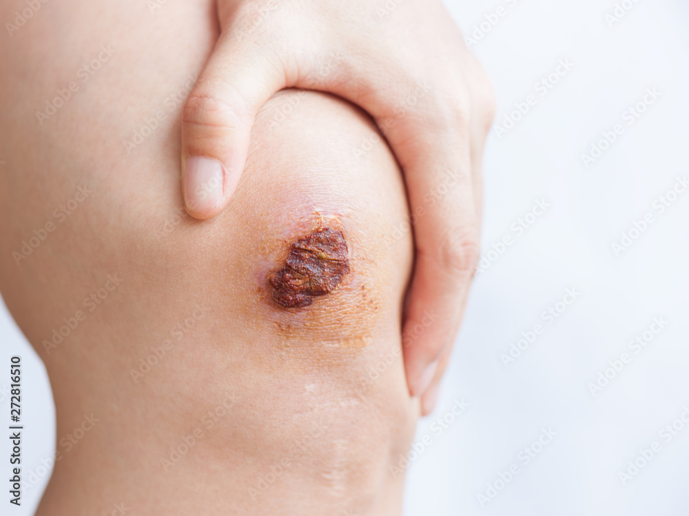 Scar and scab (eschar) on asian female knee Scar and scab (eschar) on asian female knee