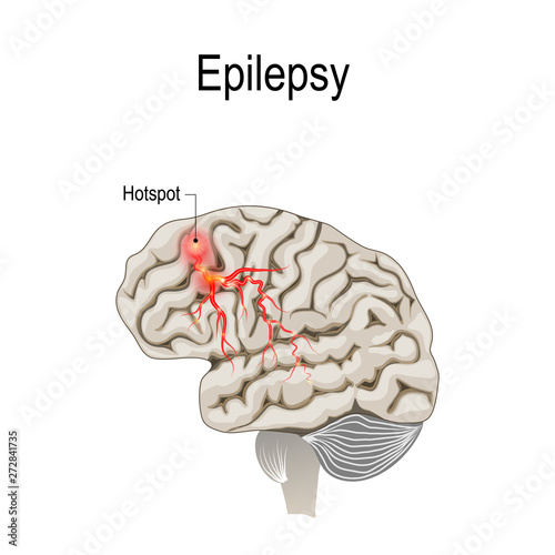 Human brain with hotspot hotspot of epilepsy