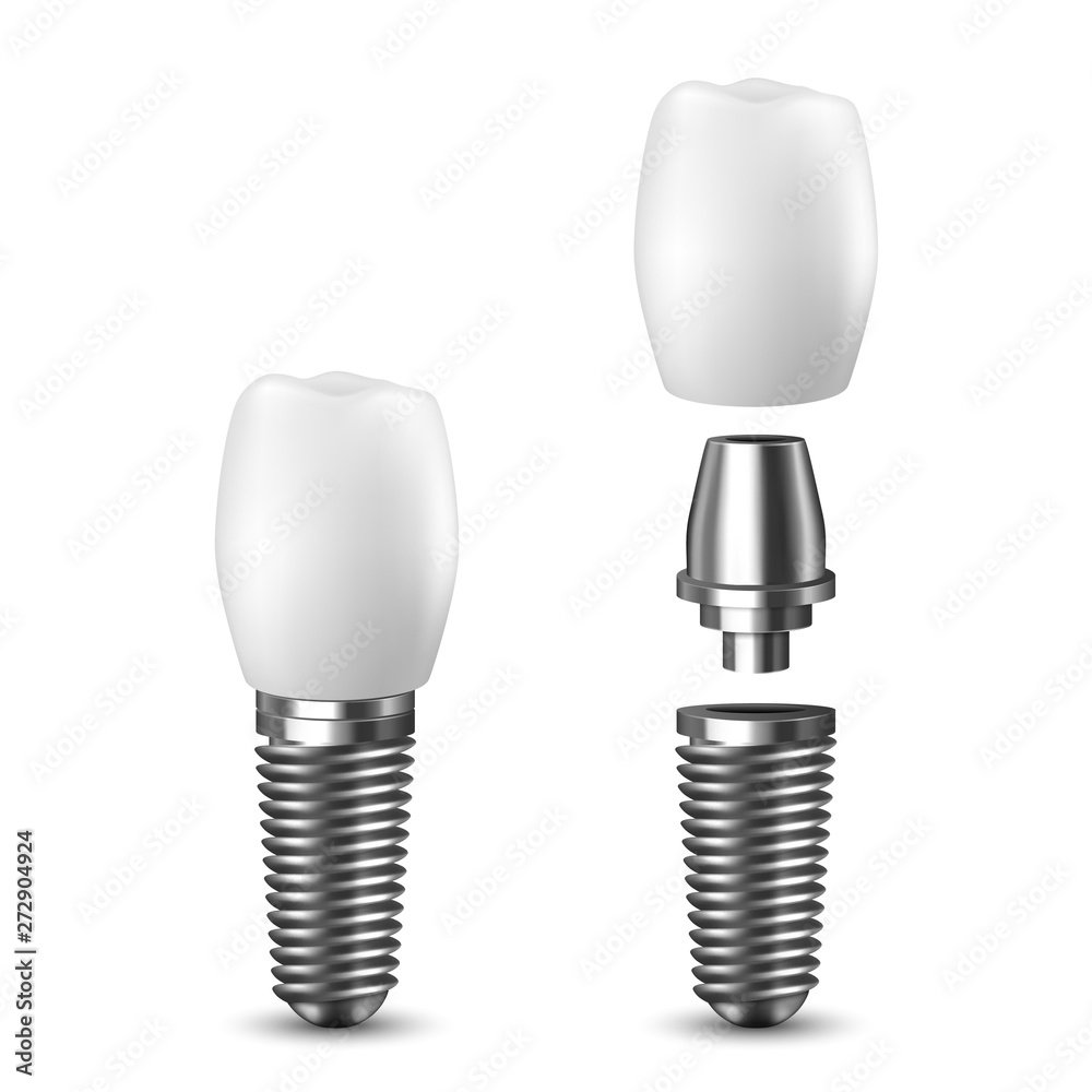 Vector 3d Realistic Render White Tooth Implant Denture Icon Set Closeup Isolated on White Background. Dental, Medicine and Health Concept. Design Template of Prosthesis Structure. Front View Vector 3d Realistic Render White Tooth Implant Denture Icon Set Closeup Isolated on White Background. Dental, Medicine and Health Concept. Design Template of Prosthesis Structure. Front View