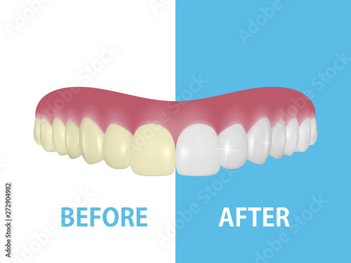 Vector Background with 3d Realistic Render Denture Set Closeup Isolated. Dentistry and Orthodontics Design. Human Teeth for Medical and Toothpaste Concept. Healthy Oral Hygiene, Jaw Prosthesis