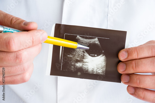 Hepatic or liver cyst on ultrasound image concept photo. Doctor indicating by pen on printed picture ultrasound pathology - hepatic cyst with cavity. Photo for diagnosis, radiology, gastroenterology