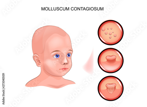 Molluscum contagiosum in a child. photo