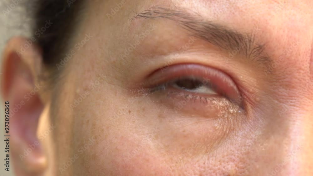 A stye, a hordeolum, a bacterial infection of an oil gland in the