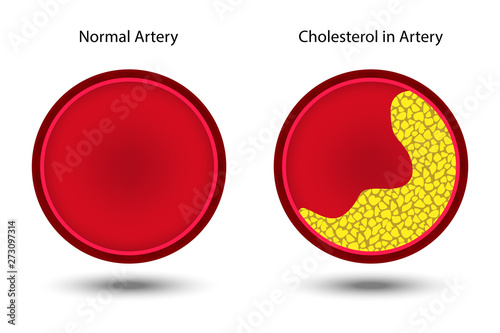 Comparison between normal artery and cholesterol in artery vector ESP10