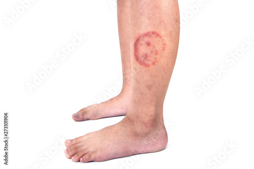 Ringworm infection or Tinea corporis on skin isolated on white background,  Dermatophytosis on skin isolated