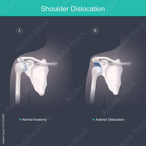 This is use for explain and compare when the head of the humerus is out of the shoulder joint include shoulder pain. Anatomy body human illustration.