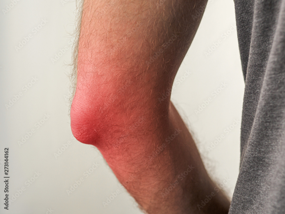 Naklejka premium man with painful elbow or with inflammation