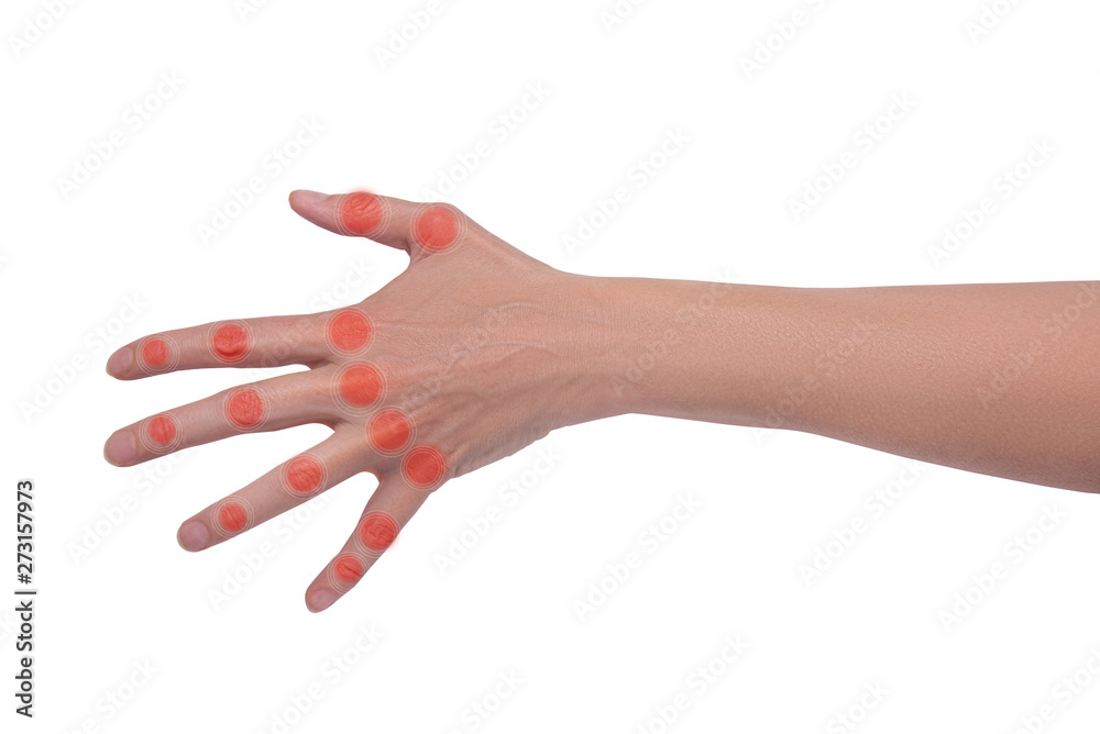 Woman hand with illnes, arthritis
